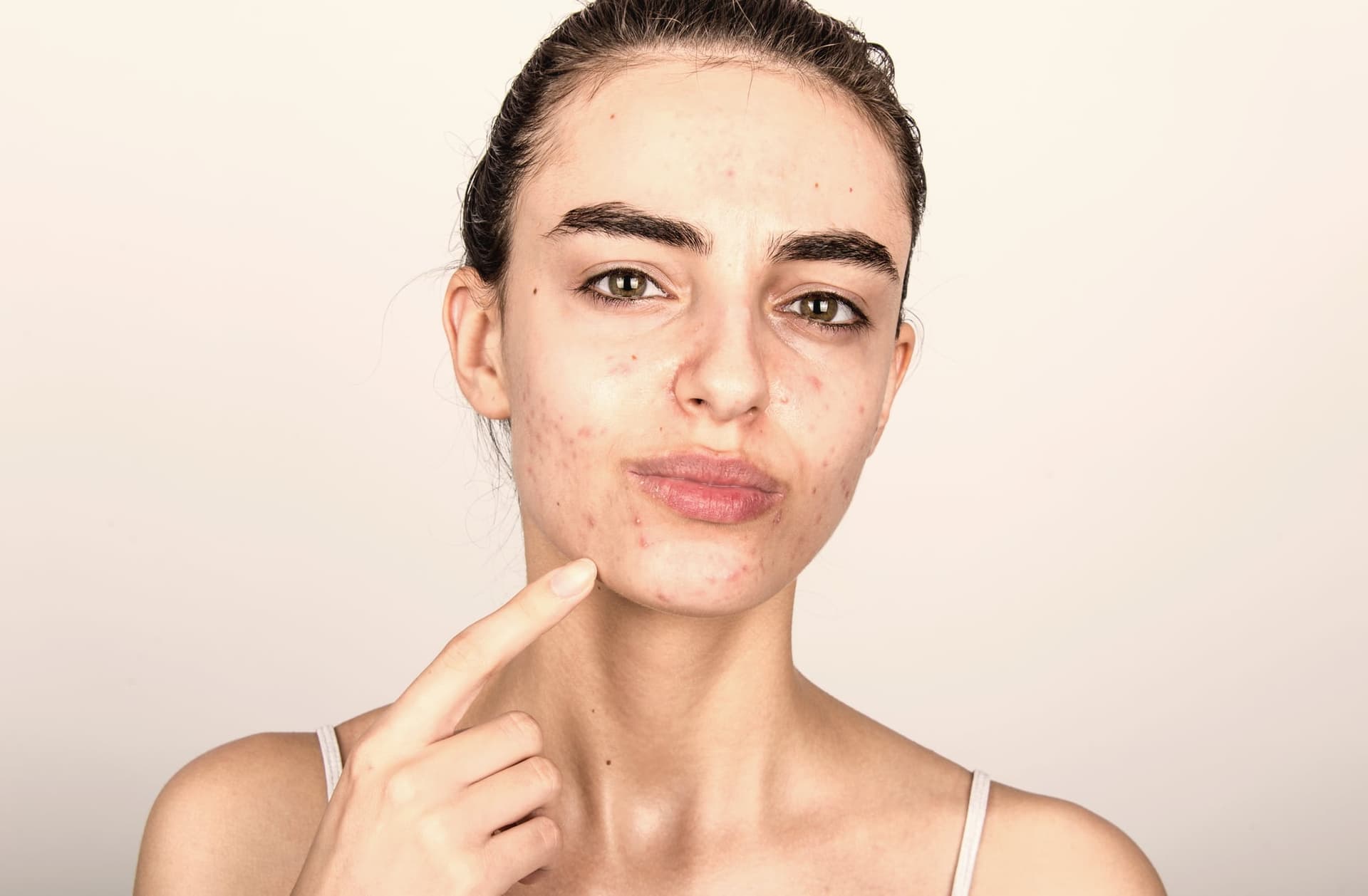 Young woman with visible acne pointing to her chin