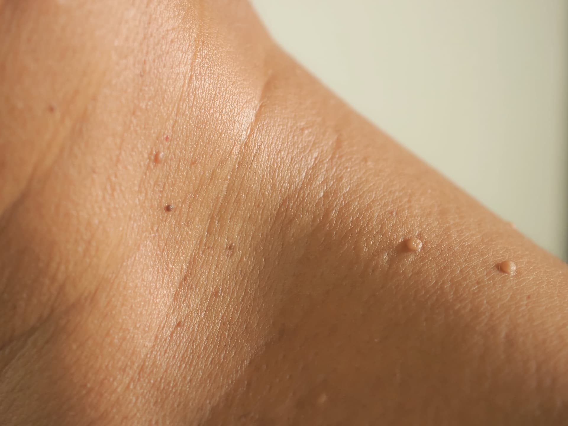 Close-up of small skin tags on a person's neck and shoulder