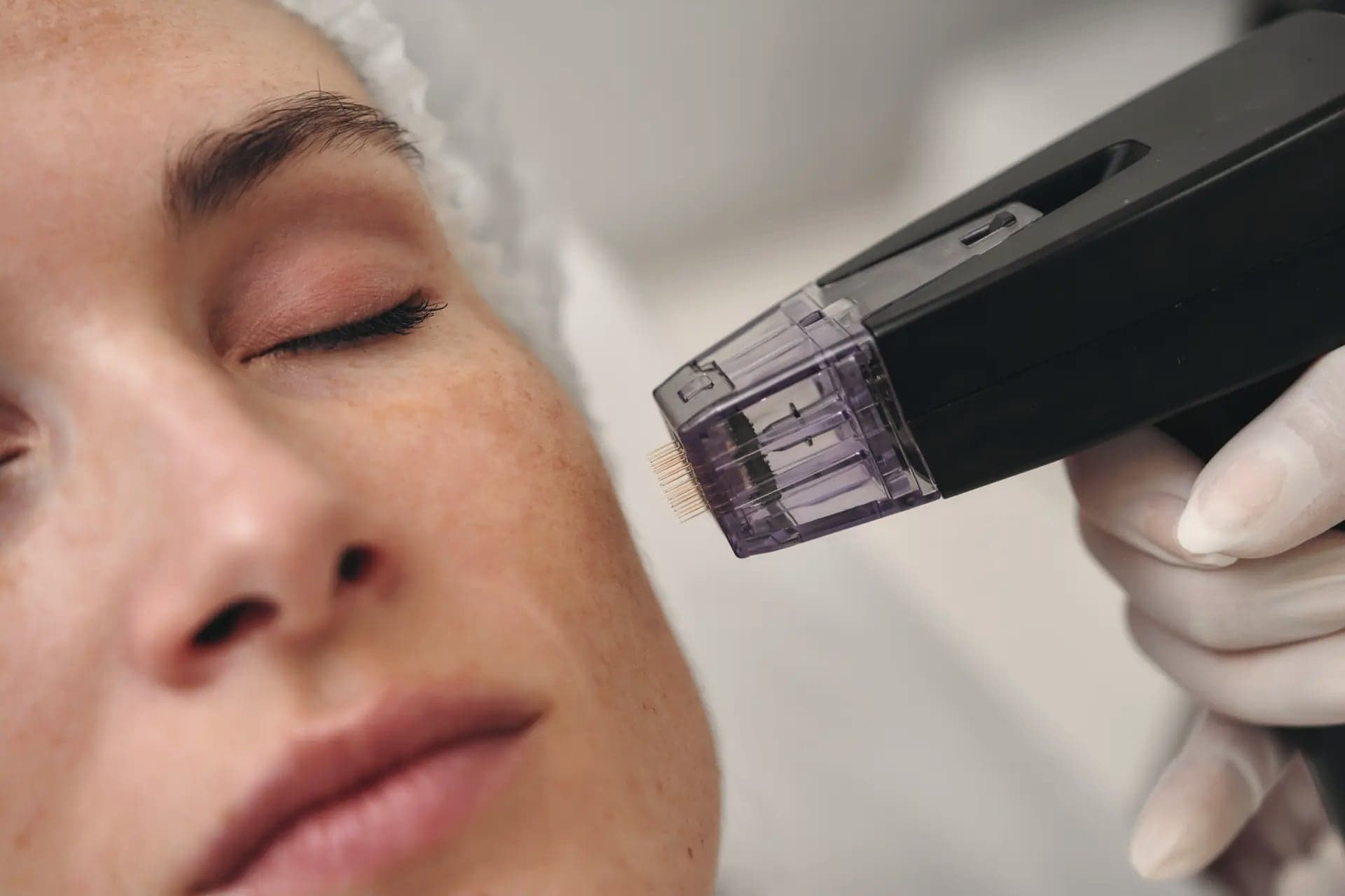 Close-up of an RF microneedling device near a woman's eye