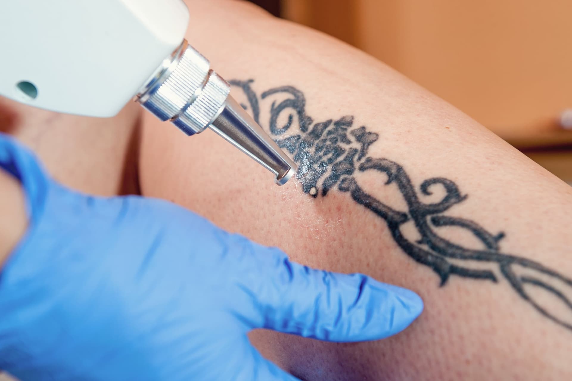 Laser handpiece treating a tribal tattoo on a person's forearm