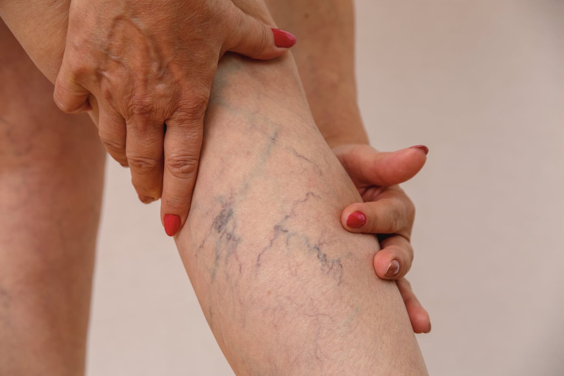 Close-up of visible spider veins on a woman's lower leg